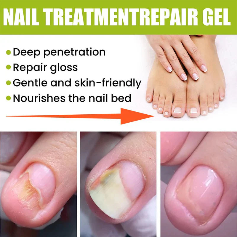 EELHOE – Nail Treatment Repair Gel My Store 2